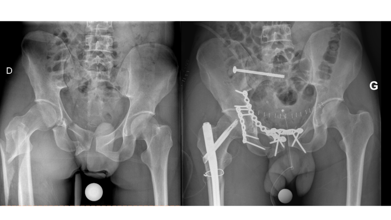 Osteosynthese Polytrauma