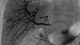 Angiographie du foie avant un traitement par chimiothérapie directement appliquée dans les artères irriguant la tumeur