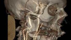 Darstellung der Halsschlagadern nach 3D-Rekonstruktion durch CT